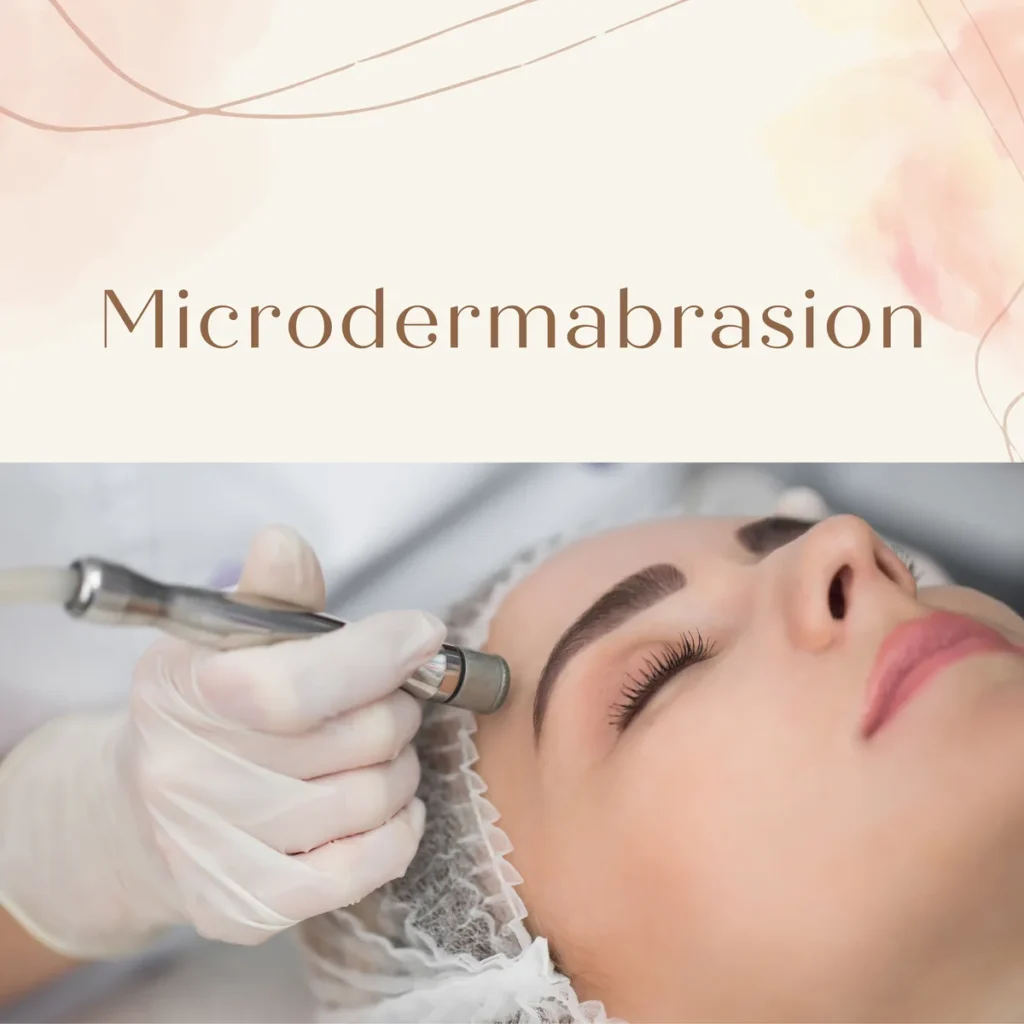 Microdermabrasion skin resurfacing treatment at SKINON in Hamilton, Ontario